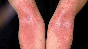 Know More About Eczema/Dermatitis